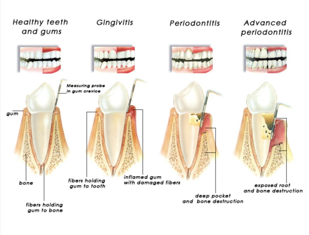 3 Things You Need To Know About Deep Teeth Cleaning 2