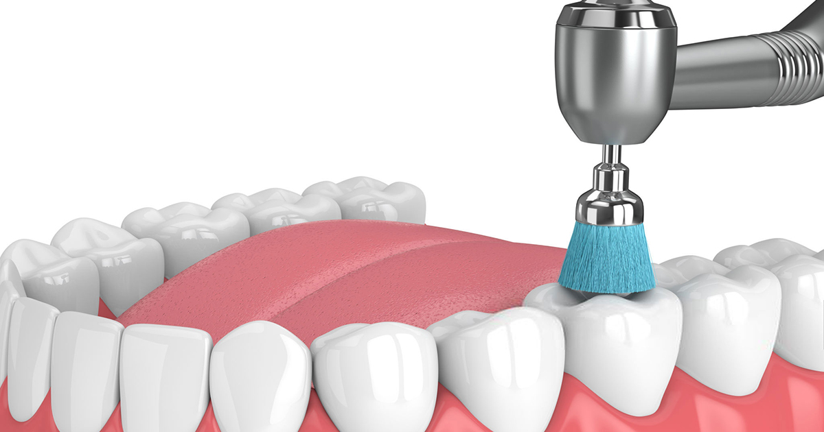 3 Things You Need To Know About Deep Teeth Cleaning 3