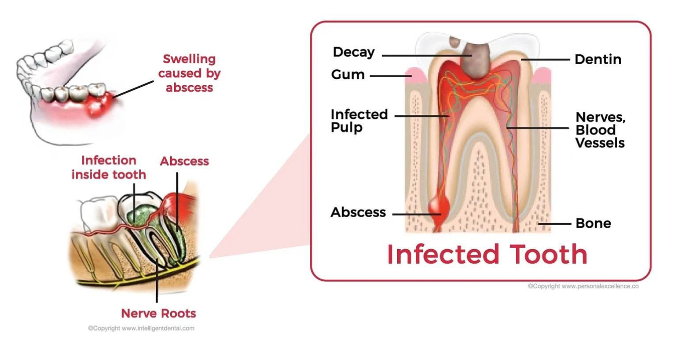 Top 3 Toothaches You Can Experience 2