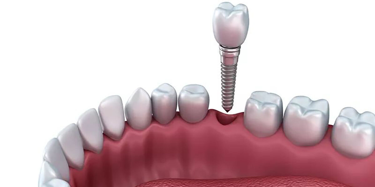 Best reasons to choose dental implants