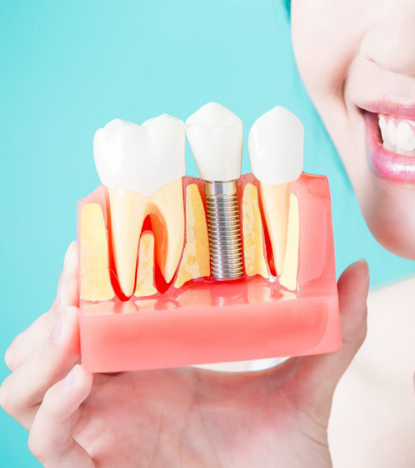 Best reasons to choose dental implants 2