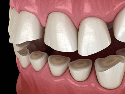 Damege Resulting from Teeth Clenching or Grinding 1