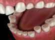 bruxism-3D-illustration