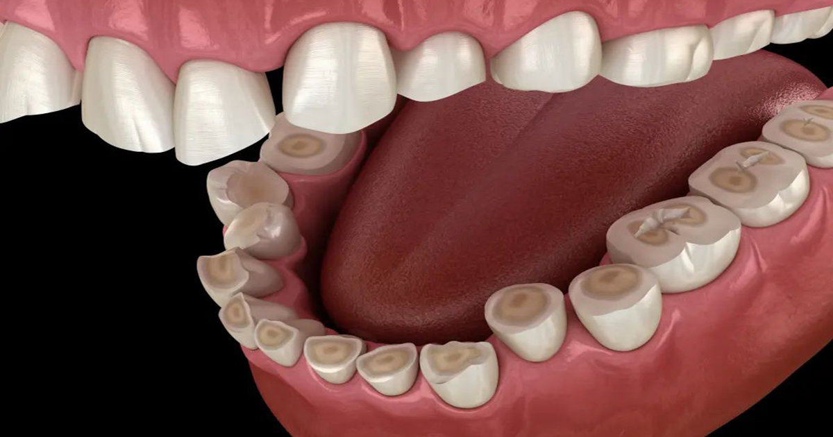 bruxism-3D-illustration
