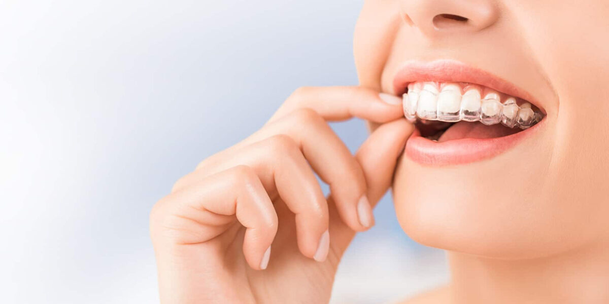 5 Advantages of choosing Invisalign 5 Advantages of choosing Invisalign