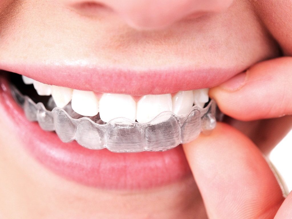 Clear Invisalign tray over teeth