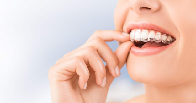 5 Advantages of choosing Invisalign 5 Advantages of choosing Invisalign