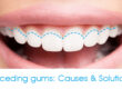 5 Signs that you have Gum Disease copy