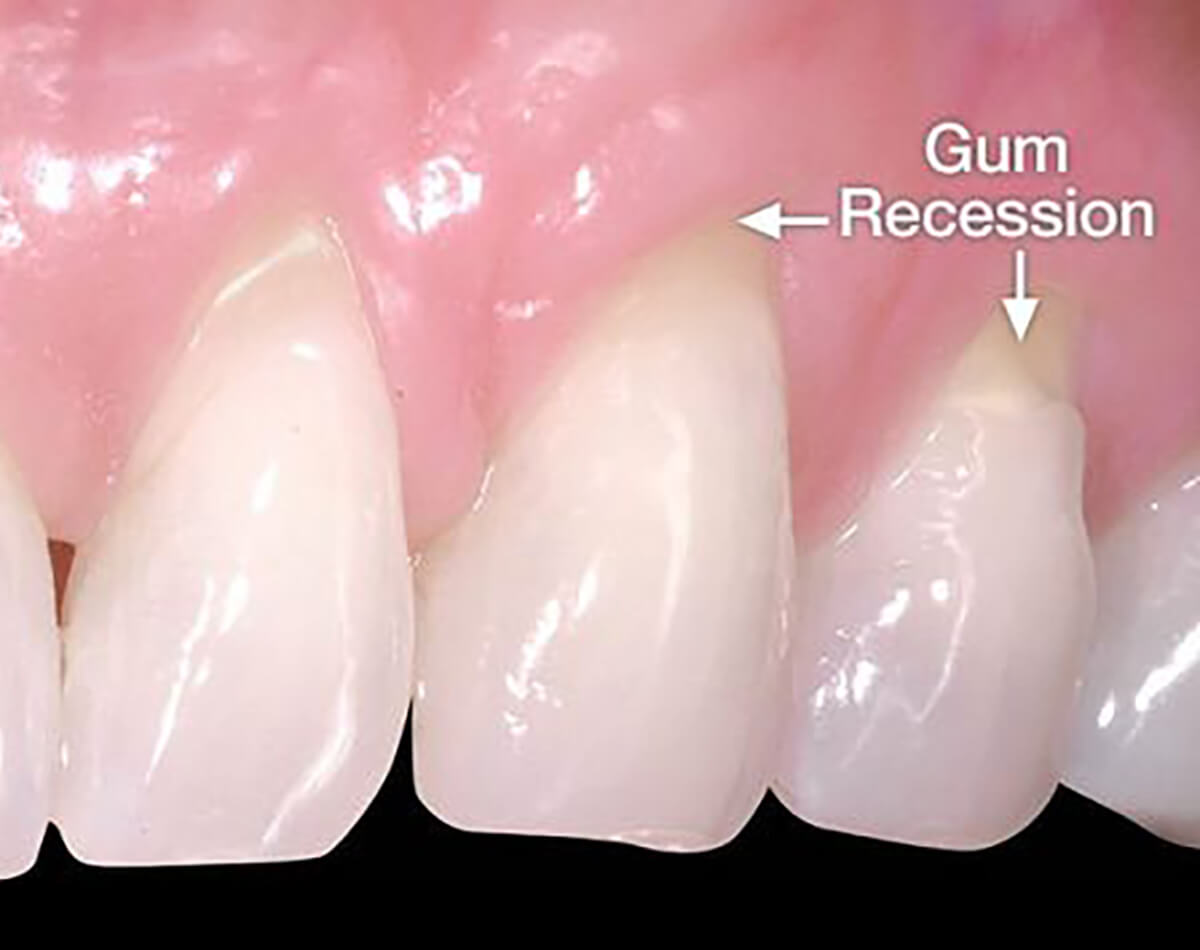 COMP-gum-recession