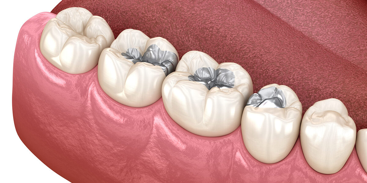 Top 5 reasons to replace your Amalgam fillings