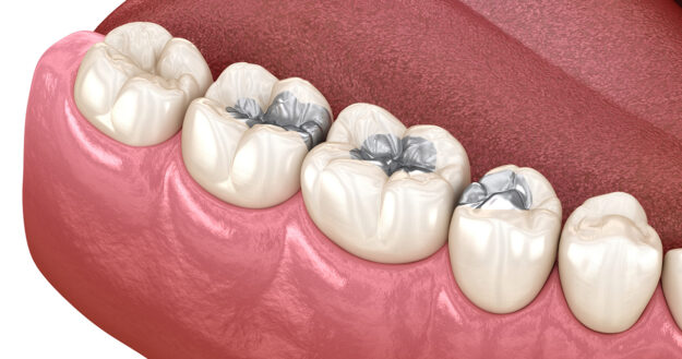 Top 5 reasons to replace your Amalgam fillings