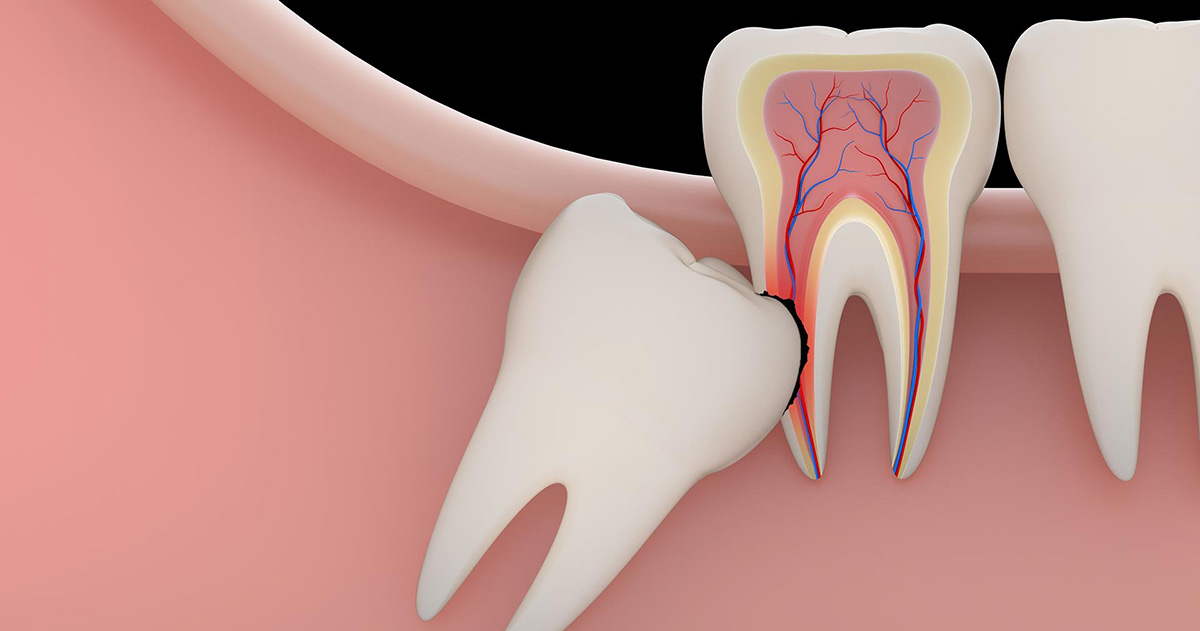 10 Warning Signs your Wisdom Teeth need to be removed 1 10 Warning Signs your Wisdom Teeth need to be removed 1