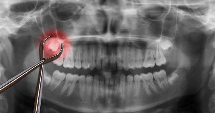 10 Warning Signs your Wisdom Teeth need to be removed 2