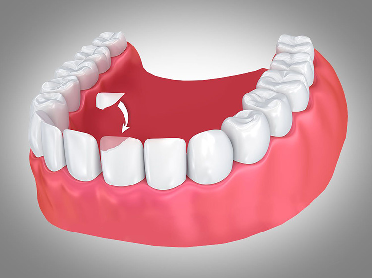 5 advantages of Dental Cosmetic Bonding 1