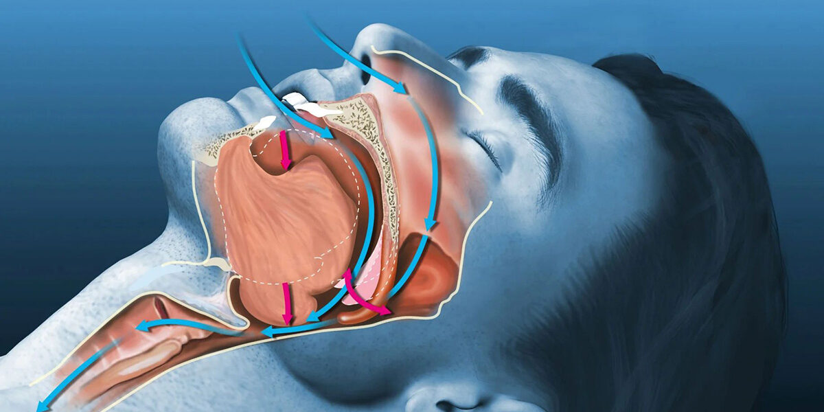 CAN SLEEP APNEA CONTROLLED BY MY DENTIST 1 CAN SLEEP APNEA CONTROLLED BY MY DENTIST 1