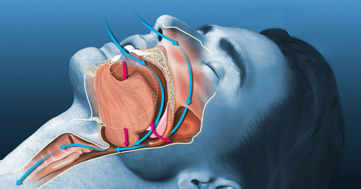 CAN SLEEP APNEA CONTROLLED BY MY DENTIST 1 CAN SLEEP APNEA CONTROLLED BY MY DENTIST 1