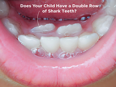 When to Be Concerned When Baby Teeth Don't Fall Out