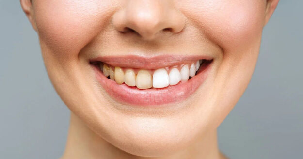 4 Causes of Yellow Teeth and How to Treat Them 4 Causes of Yellow Teeth and How to Treat Them