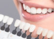 5 Motivators to Consider Teeth Whitening 2
