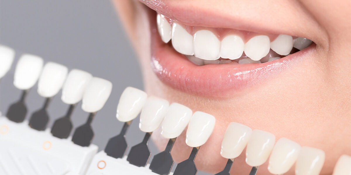 5 Motivators to Consider Teeth Whitening 2 5 Motivators to Consider Teeth Whitening 2