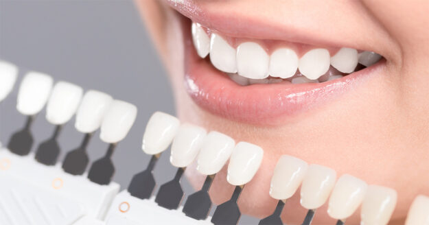 5 Motivators to Consider Teeth Whitening 2