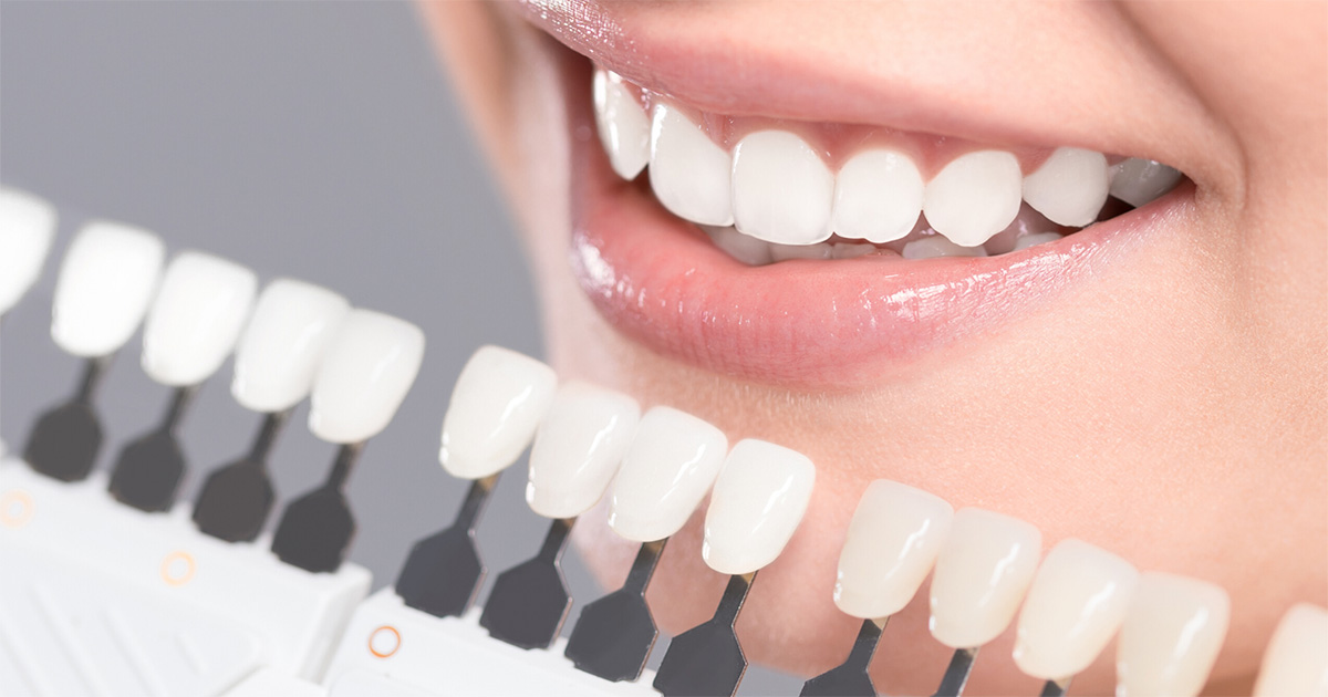 5 Motivators to Consider Teeth Whitening 2 5 Motivators to Consider Teeth Whitening 2