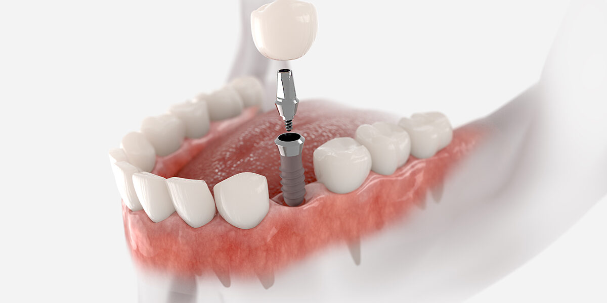 5 top reasons Dental Implants are one of the best choice for tooth replacement 5 top reasons Dental Implants are one of the best choice for tooth replacement