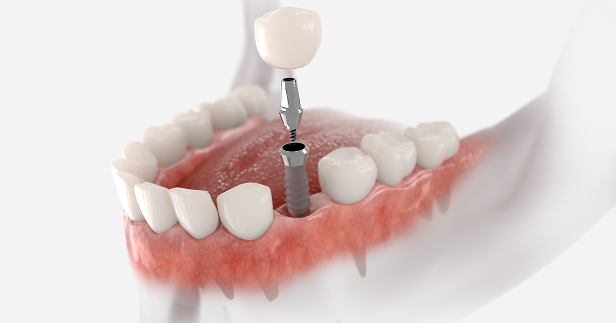 5 top reasons Dental Implants are one of the best choice for tooth replacement 5 top reasons Dental Implants are one of the best choice for tooth replacement
