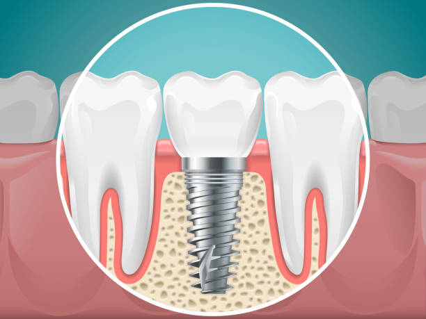 5 top reasons Dental Implants are one of the best choice for tooth replacement