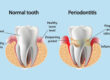 10 Important points about Periodontal Pocketing 3
