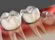 8 important points about Wisdom Teeth Removal