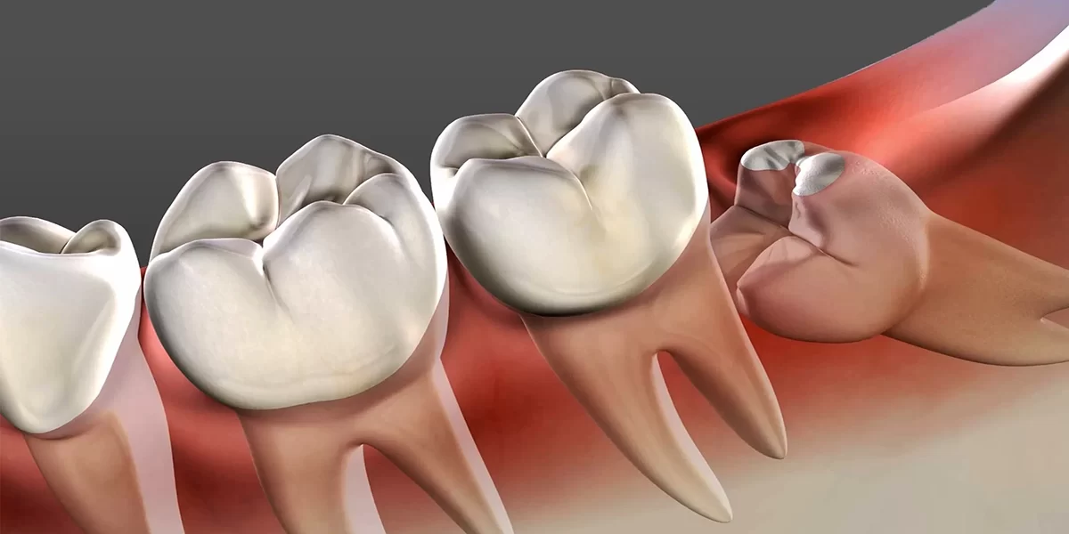8 important points about Wisdom Teeth Removal 8 important points about Wisdom Teeth Removal