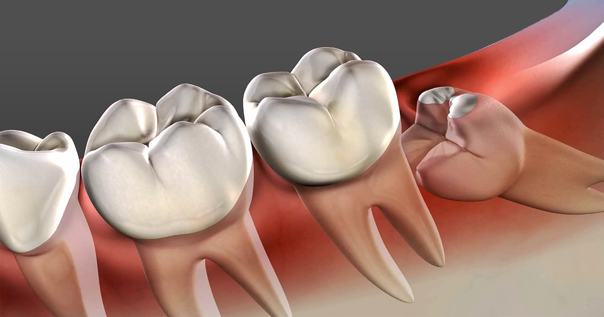 8 important points about Wisdom Teeth Removal 8 important points about Wisdom Teeth Removal