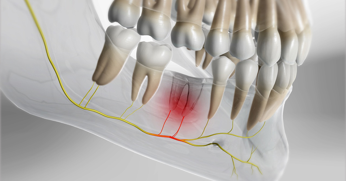Dental Dry Socket Symptoms & Treatment 2 Dental Dry Socket Symptoms & Treatment 2