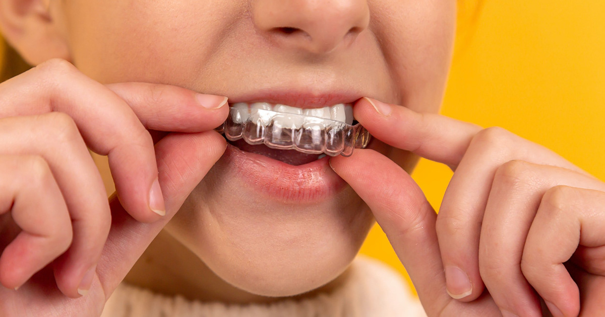 Top 5 Issues as a Result of Teeth Grinding Top 5 Issues as a Result of Teeth Grinding