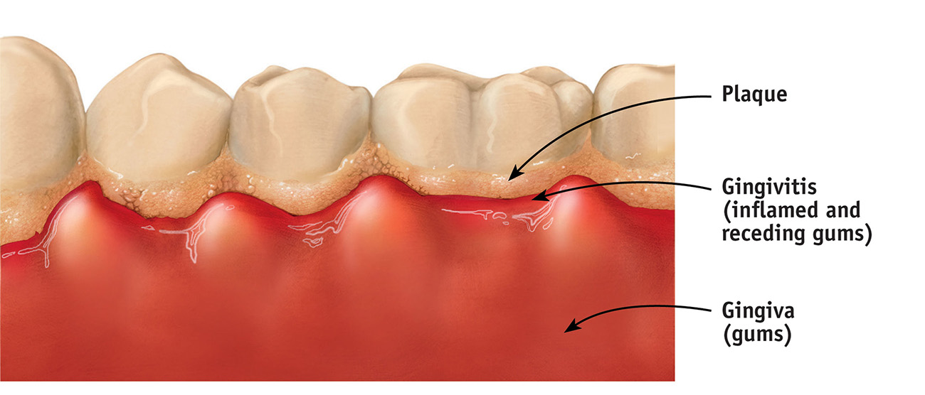 Top 5 ways to treat Dental Plaque