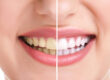 7 Top Benefits of Teeth Whitening