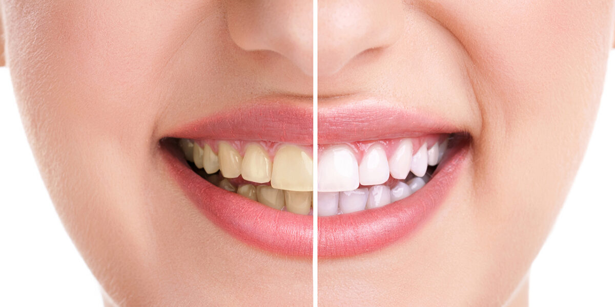 7 Top Benefits of Teeth Whitening 7 Top Benefits of Teeth Whitening