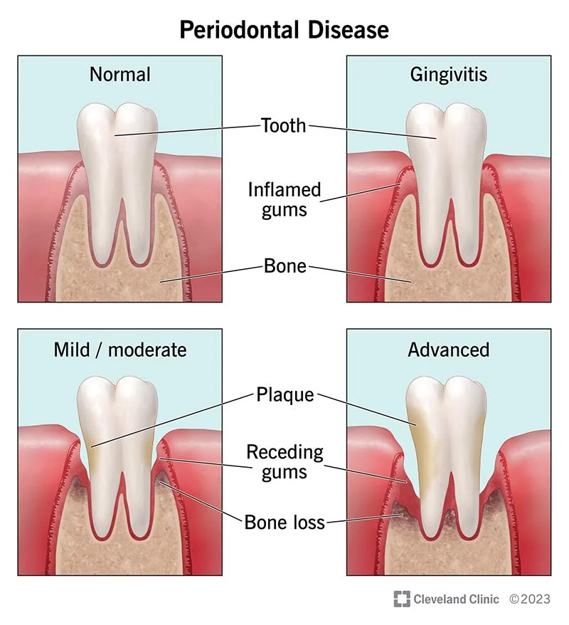 Is there a possible Link Between Periodontal Disease and Cancer 1