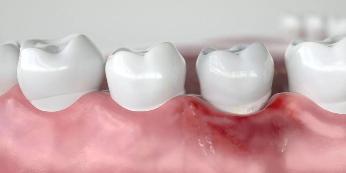 Is there a possible Link Between Periodontal Disease and Cancer 2 Is there a possible Link Between Periodontal Disease and Cancer 2