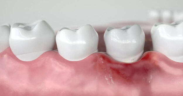 Is there a possible Link Between Periodontal Disease and Cancer 2 Is there a possible Link Between Periodontal Disease and Cancer 2