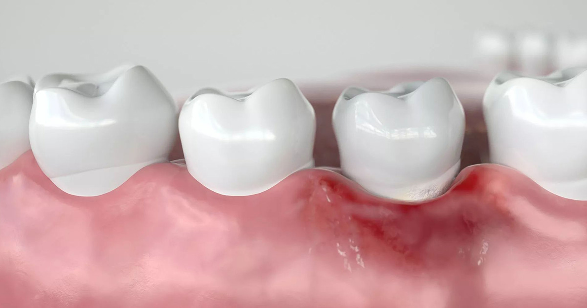 Is there a possible Link Between Periodontal Disease and Cancer 2 Is there a possible Link Between Periodontal Disease and Cancer 2