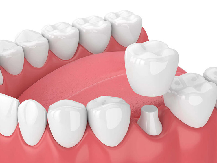 The Top 4 Benefits of Dental Crowns 2