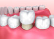 The Top 4 Benefits of Dental Crowns 3