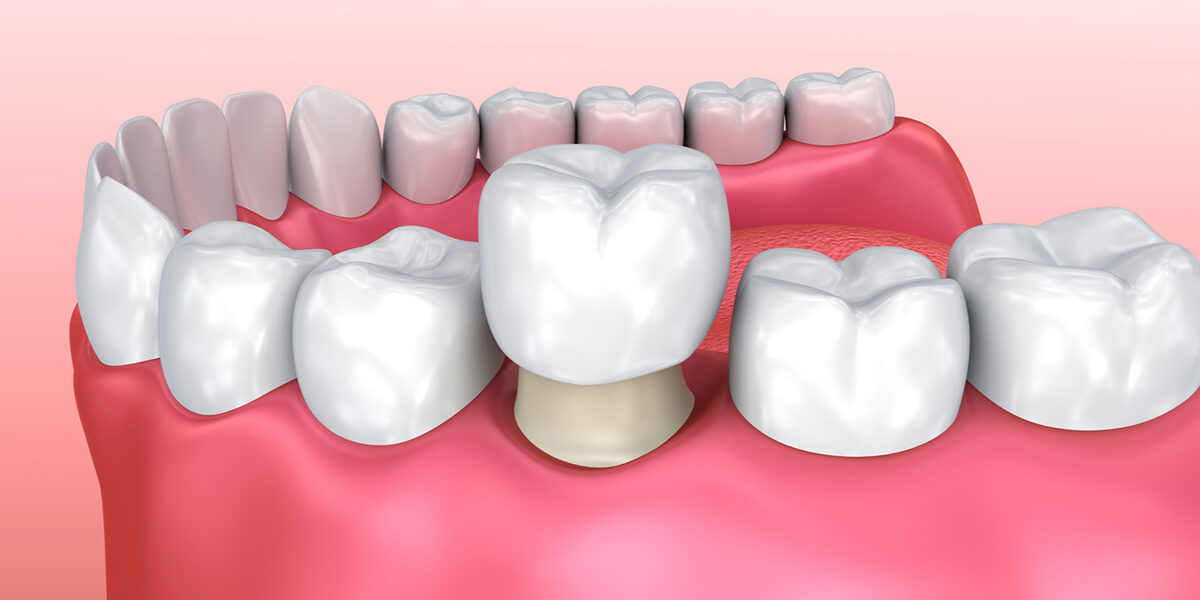 The Top 4 Benefits of Dental Crowns 3 The Top 4 Benefits of Dental Crowns 3