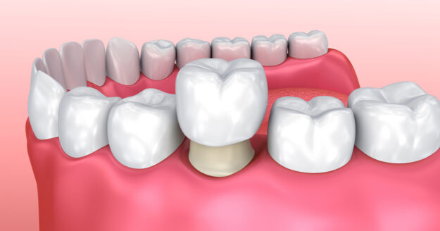 The Top 4 Benefits of Dental Crowns 3 The Top 4 Benefits of Dental Crowns 3