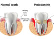 What are PERIODONTAL POCKETS and what can be done about them 1