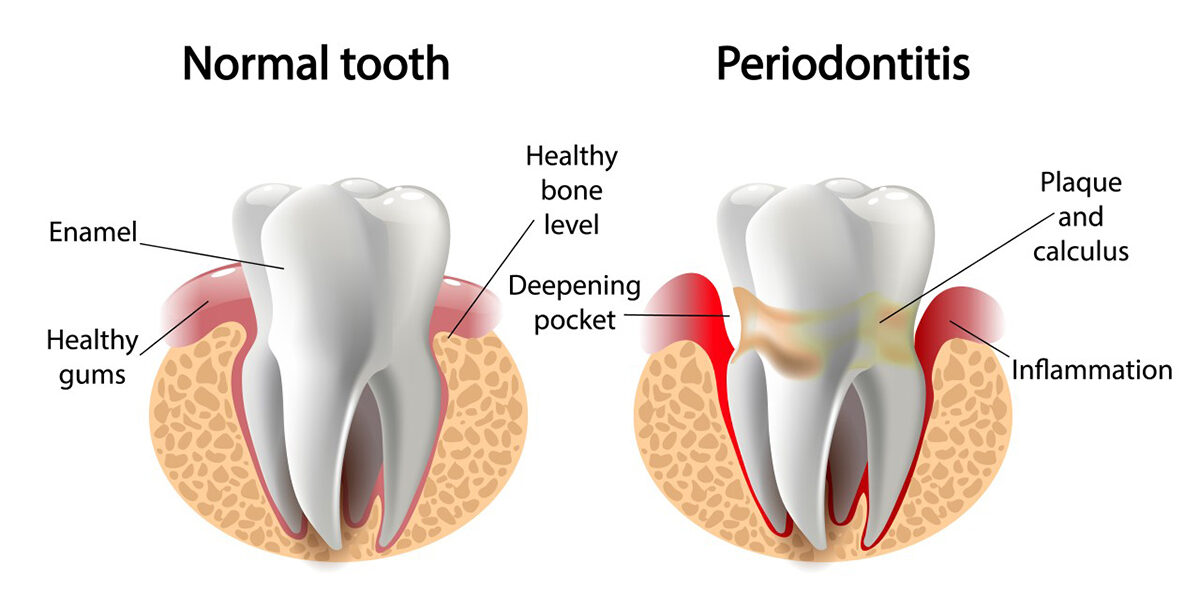 What are PERIODONTAL POCKETS and what can be done about them 1 What are PERIODONTAL POCKETS and what can be done about them 1