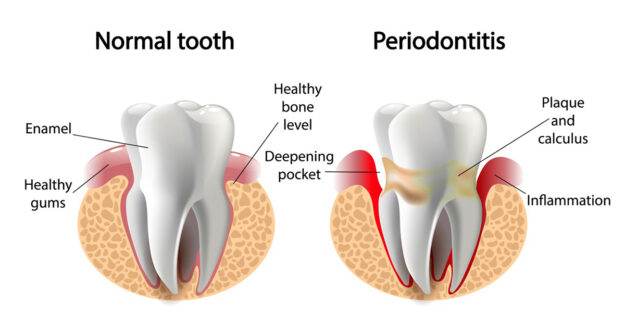What are PERIODONTAL POCKETS and what can be done about them 1 What are PERIODONTAL POCKETS and what can be done about them 1