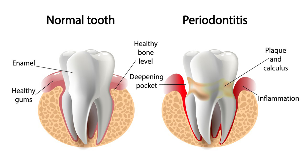 What are PERIODONTAL POCKETS and what can be done about them 1 What are PERIODONTAL POCKETS and what can be done about them 1